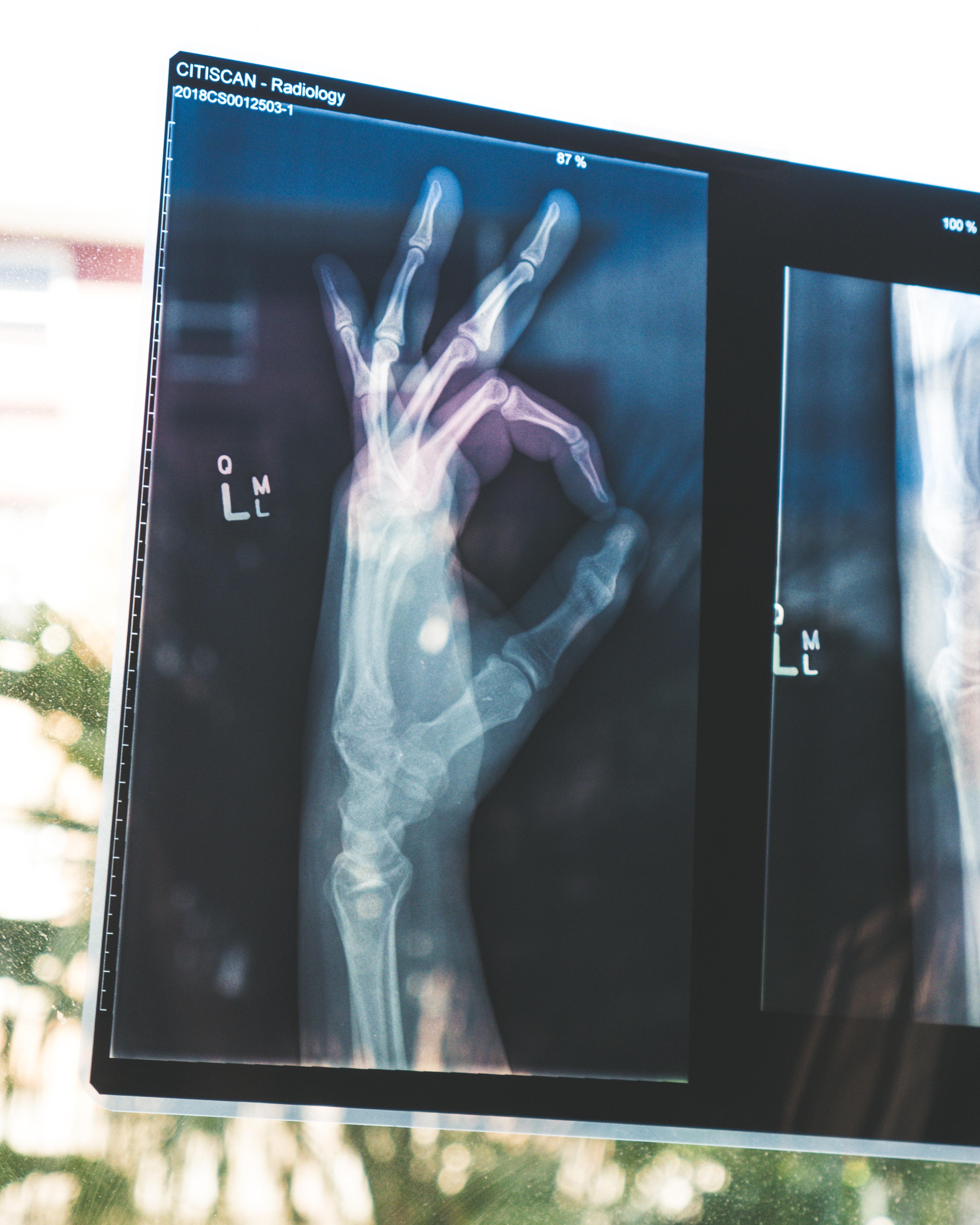 Xray hand photo